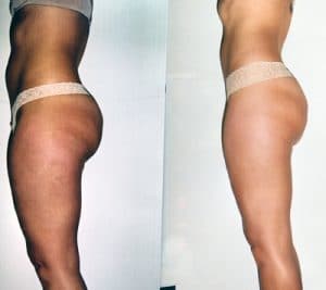 Aesthetics Spa Oakmont PA Before After