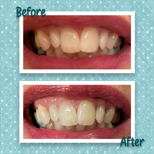 Aesthetics Spa Oakmont PA Teeth Whitening Before After