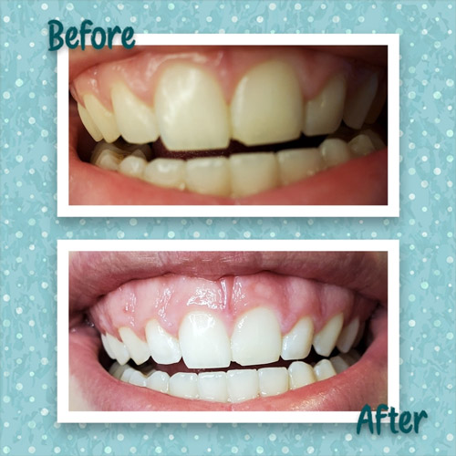 Aesthetics Spa Oakmont PA Teeth Whitening Before After