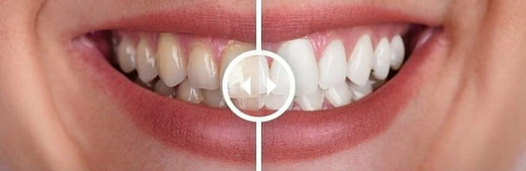 Aesthetics Spa Oakmont PA Teeth Whitening Before After