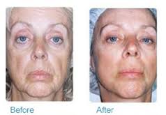 Med Spa Oakmont PA Before After