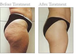 Med Spa Oakmont PA Before After