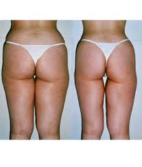 Med Spa Oakmont PA Before After