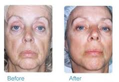 Aesthetics Spa Oakmont PA Before And After 