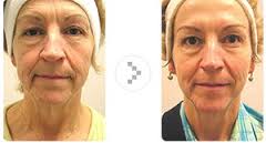 Aesthetics Spa Oakmont PA Before And After