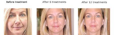 Aesthetics Spa Oakmont PA Before And After
