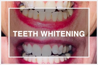 Aesthetics Spa Oakmont PA Teeth Whitening